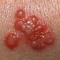 اگر زگیل دارید این آگهی برای شماست|خدمات زیبایی و سلامت|تهران, والفجر|دیوار