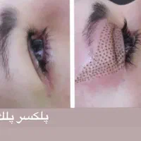 فیشال.پلاسما.پکیج هایفو.آراف.مزونیدلینگ|خدمات آرایشگری و زیبایی|شیراز, میانرود|دیوار
