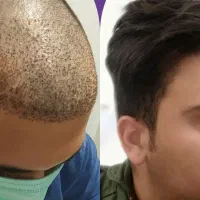 کاشت مو و کاشت ابرو، میکروگرافت|خدمات آرایشگری و زیبایی|کرمانشاه, |دیوار