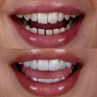 جشنواره افتتاحیه دندانپزشکی ( بی‌حسی دیجیتال)
