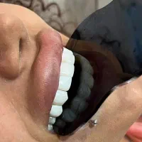 جشنواره کامپوزیت 8000 م ،عصب کشی از۲۵۰۰ توسط پزشک