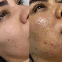 فیشیال پوست با تخفیف ویژه|آرایشگاه و سالن‌های زیبایی|قم, کلهری|دیوار