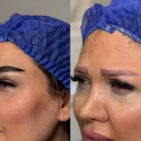 کاشت ابرو با بیشترین تراکم