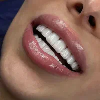 کامپوزیت دندان فقط واحدی 1 تومن اقساطی/عصب کشی و..