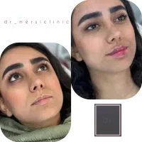 فوری فوری تخفیف٪۵۰ ژل بوتاکس برای شب یلدا|خدمات آرایشگری و زیبایی|اردبیل, |دیوار