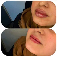 تزریق ژل لب بوتاکس مزوتراپی فیلر صورت در تهران|خدمات آرایشگری و زیبایی|تهران, فلسطین (میدان انقلاب)|دیوار