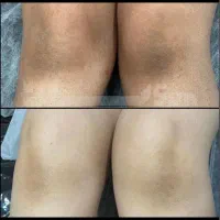 لیزر الکس با ضمانت نامه کتبی بدون درد فقط ۹۸۰