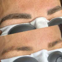 ریموو تاتو صورت و بدن با لیزر کیوسوییچ امریکایی|خدمات آرایشگری و زیبایی|گرگان, |دیوار