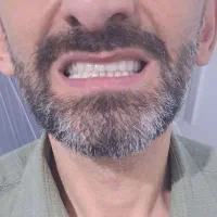جشنواره دندان مصنوعی دستی10ملیون تومن به مدت محدود