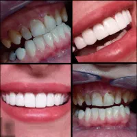 کامپوزیت زیبایی جشنواره ی تخفیفی یلدا|خدمات آرایشگری و زیبایی|کوهدشت, |دیوار