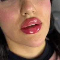 انجام بوتاکس فیلر ژل مزو    اقساط بدون پیش پرداخت
