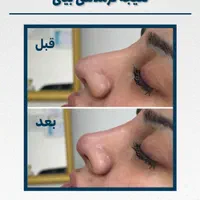 ژل لب بوتاکس فیلر انزیم کامپوزیت دندان|خدمات آرایشگری و زیبایی|مشهد, راهنمایی|دیوار