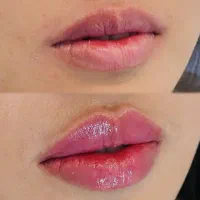 تزریق فیلر و بوتاکس مزوژل جوانساز
