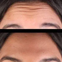 جشنواره تزریق ژل و بوتاکس در کلینیک فقط۶۰۰|خدمات آرایشگری و زیبایی|ساری, |دیوار