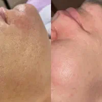 پاکسازی پوست ۲۵۰ تومن مدت محدود