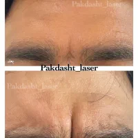 تزریق بوتاکس مصپورت ، کامل صورت توسط پزشک|خدمات آرایشگری و زیبایی|پاکدشت, پاکدشت (مامازند)|دیوار