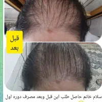 پک ریزش مو برای اولین بار در ایران|آرایشی، بهداشتی، درمانی|قم, چهار مردان|دیوار