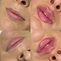 ژل فیلر بوتاکس مزو هایفو لب|خدمات آرایشگری و زیبایی|اسلامشهر, شهرک قائمیه|دیوار