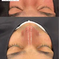 جشنواره عمل بینی به سبک جراحان ترکیه|خدمات آرایشگری و زیبایی|لامرد, |دیوار