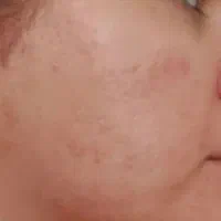 تخفیف مزو نیدلینگ و پرسینگ