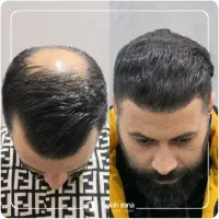 کاشت مو|خدمات آرایشگری و زیبایی|اهواز, نادری|دیوار