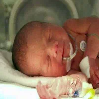 سوند تغذیه نوزاد (OGT / لوله معده) در منزل و مرکز