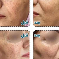 فروش مواد زگیل تناسلی تضمینی با ی بار استفاده|خدمات آرایشگری و زیبایی|یاسوج, |دیوار