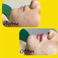 خدمات زیبایی توسط متخصص بلفارو بوتاکس لیفت زاویه|خدمات آرایشگری و زیبایی|اصفهان, گلزار|دیوار