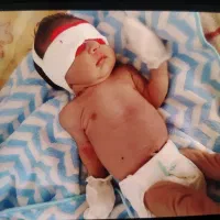 زردی نوزادان