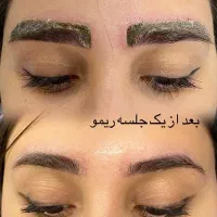ریموو،آرایش دائم،رشد مجدد موMEG