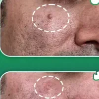 برداشتن خال و لک