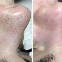 پاکسازی پوست تخصصی|خدمات آرایشگری و زیبایی|اسلامآباد غرب, |دیوار