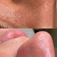 پاکسازی و جوانسازی صورت|خدمات آرایشگری و زیبایی|جم, |دیوار