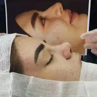 عمل بینی با تخفیف جشنواره تابستانه ویژه فقط ۲۵تومن|خدمات آرایشگری و زیبایی|تهران, عباس‌آباد|دیوار