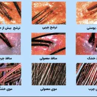 اسکراب اسکالپ در کلینیک تخصصی مو نوراویس|خدمات آرایشگری و زیبایی|مشهد, ملک‌آباد|دیوار