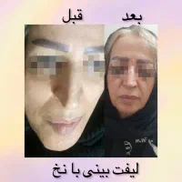 ژل بوتاکس ساکشن چربی نخ لیزر PRPجراحی زیبایی سهند|خدمات آرایشگری و زیبایی|سهند, |دیوار