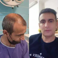 کاشت تخصصی مو و ابرو با ضمانت نامه واقساط