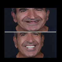 ایمپلنت دیجیتال/فوری/کاشت دندان/جراحی/دندانپزشکی|خدمات آرایشگری و زیبایی|تهران, سلسبیل شمالی|دیوار
