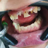 عصب کشی ایمپلنت روکش ترمیم کشیدن بلیچینگ لمینیت|خدمات آرایشگری و زیبایی|ساری, |دیوار