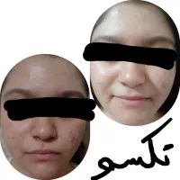 جوش صورت و چین چروک