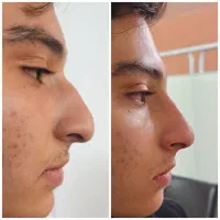 ژل بوتاکس زیبایی بینی لیفت صورت و بدن|خدمات آرایشگری و زیبایی|مشهد, هفت تیر (آب و برق)|دیوار