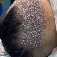 کاشت طبیعی مو ،ابرو،ریش،سیبیل|خدمات زیبایی و سلامت|شیراز, زرگری|دیوار