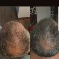 قبل اینکه موهاتو کامل از دست بدی اینو ببین