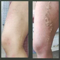 درمان تخصصی واریس