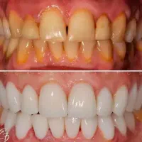 جشنواره کامپوزیت،لمینیت وبلیچینگ وخدمات دندانپزشکی|خدمات آرایشگری و زیبایی|شاهین‌شهر, مخابرات (شهید بهشتی)|دیوار