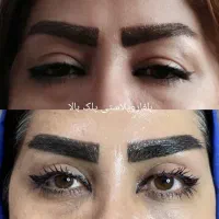 جشنواره بلفاروپلاستی پلک غبغب سانترال ژل چربی|خدمات آرایشگری و زیبایی|قم, بلوار امین و ساحلی|دیوار