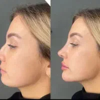 فیلر لب وبوتاکس|خدمات آرایشگری و زیبایی|مشهد, هفت تیر (آب و برق)|دیوار