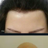 پروتز مو و ترمیم موی شقایق. چسب پروتز|خدمات آرایشگری و زیبایی|تبریز, |دیوار