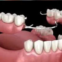 فیلیپر تک دندان