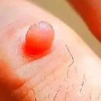 درمان ریشه ای/HPV/زگیل تناسلی/تبخال تناسلی/دیابت